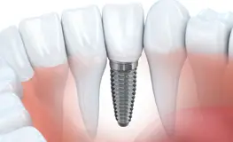 Dental Implants