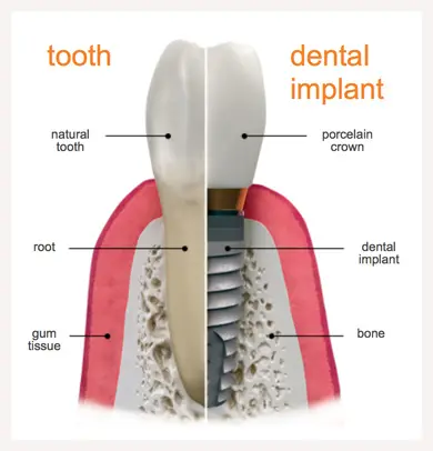 Dental Implants