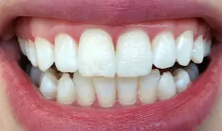 Teeth Whitening
